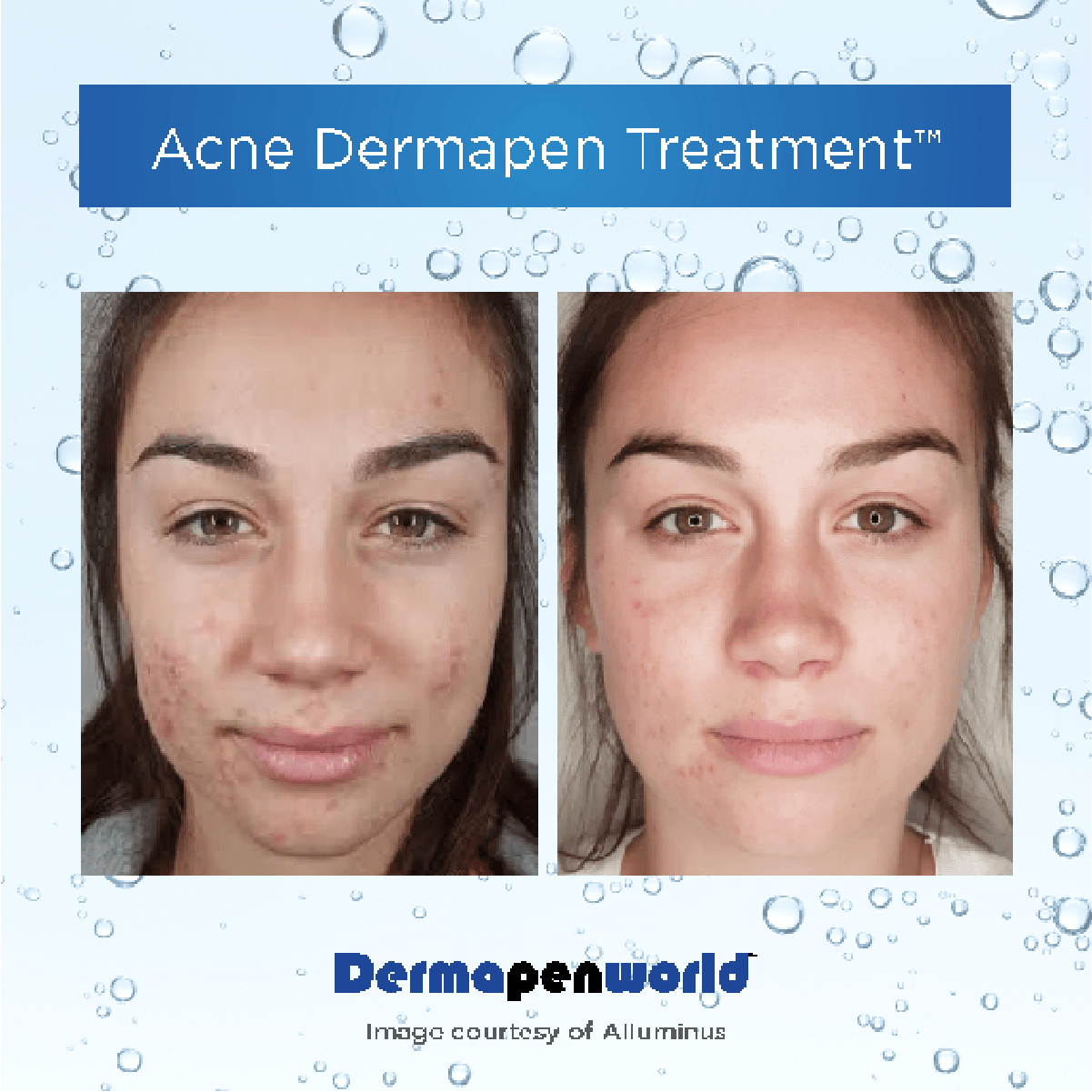 Microneedling Medinord esthétique